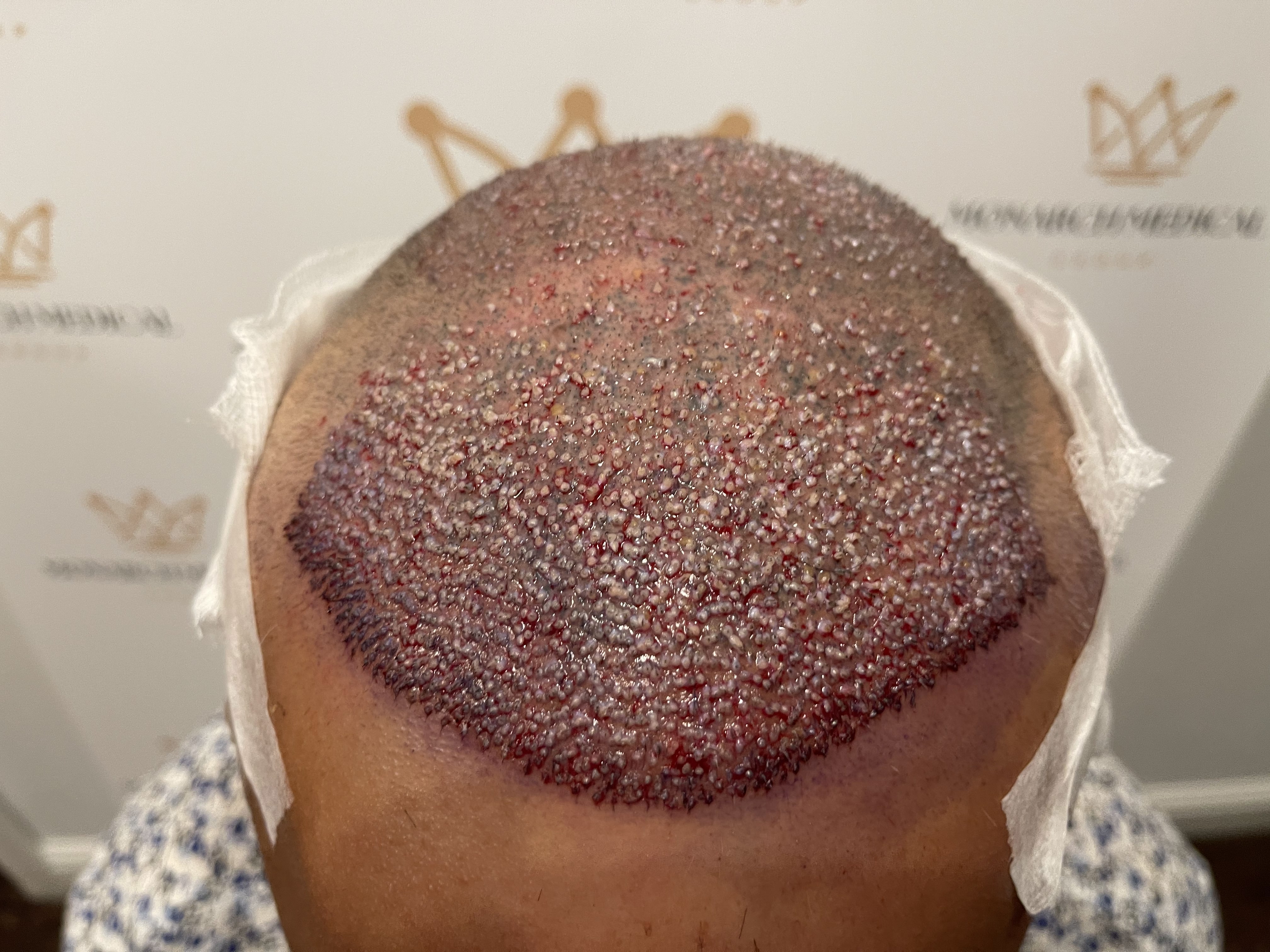 Nishant hair transplant result photo 5